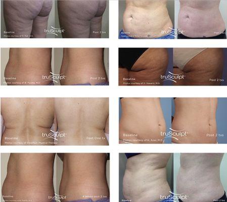 TruSculp ID, body sculpting treatment. Avg of 24% fat reduction.