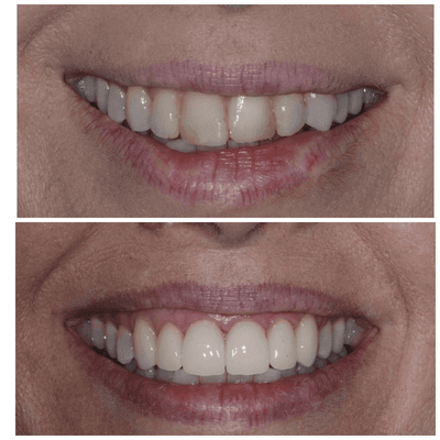 A beautiful case by one of our talented dentists, Dr. Lee.