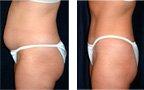 Vaser Body Contouring