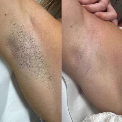 Before and after - Underarms Laser