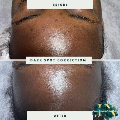 Hyperpigmentation