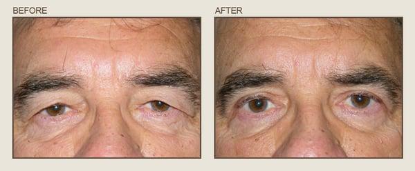 Before & After

Center for Eye & Laser Surgery- Severna Park, Maryland