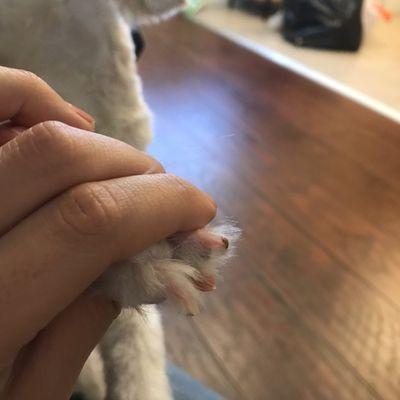 Her nail bled due to trimming too short