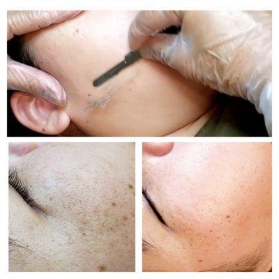 Dermaplaning