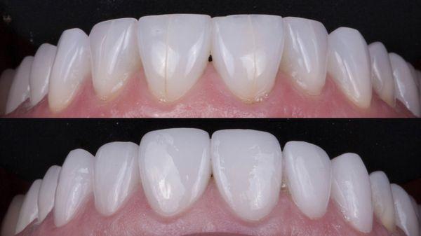 Set of Porcelain Veneers to enhance the smile.