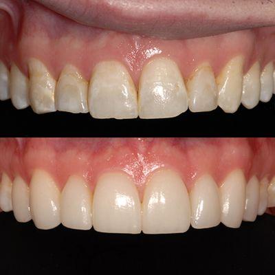 Before & After - e.max Veneers