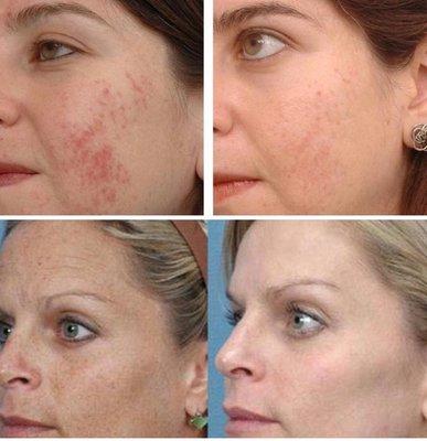 Acne and freckles treatment