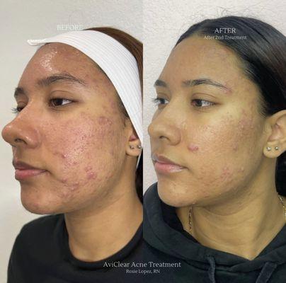 AviClear Acne Treatment