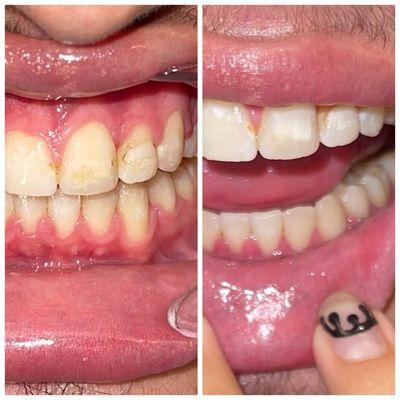 Teeth whitening before and after