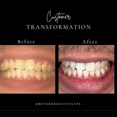 Laser Teeth Whitening