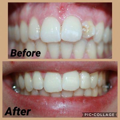 Some amazing crown work form Dr. Bautista! Could you tell the difference if there was no before picture?