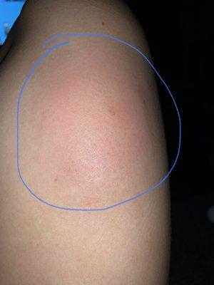 Bed bug bite 1/10