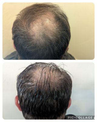 Hair restoration 4 treatments