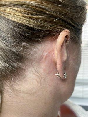 Scars right ear