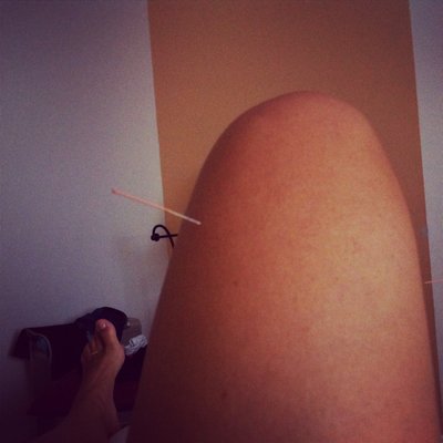 Acupuncture works for my knees. One treatment every 6 months and I have new knees.