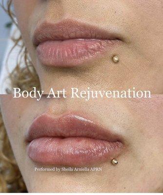 Lip filler injections.