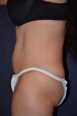 #5850 ABDOMINOPLASTY - 58 YEAR OLD, 1 YEAR POST-OP