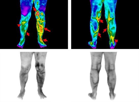 Detecting deep vein thrombosis (DVT) with thermography instead of radiation