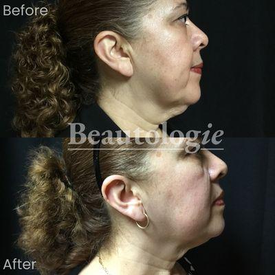 Kybella Before and After