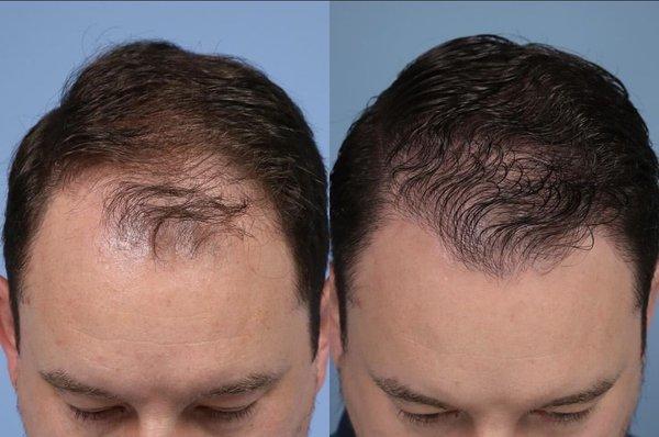 FUE Hair Restoration before and after