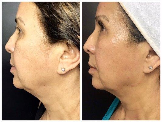 Before & After 4 skin tightening treatments using Endymed's Radio Frequency .