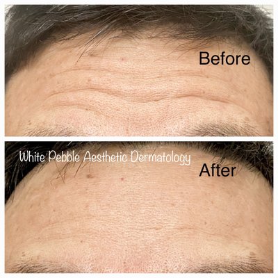 Forehead wrinkles reduction 1 week after Jeuveau (like Botox) injection.