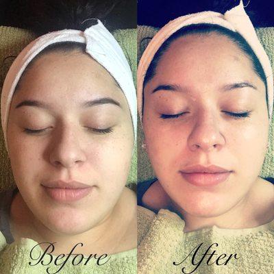 Balancing her skin out with a peptide mask and microdermabrasion Facial