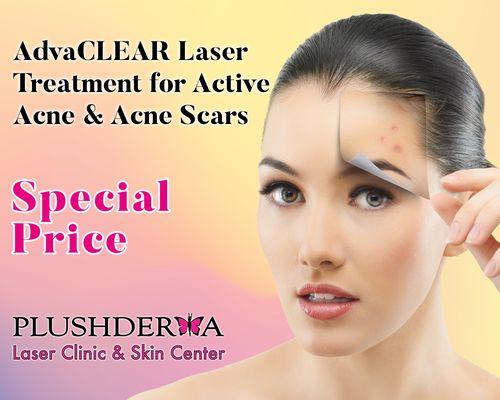 Now offering ADVAClear Laser Treatment for Active Acne & Acne Scars. Call us to learn more!