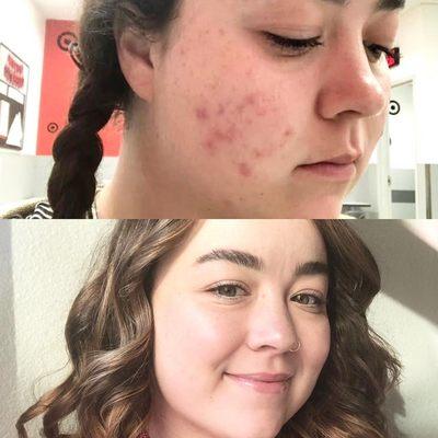 Chemical Peel Before and after