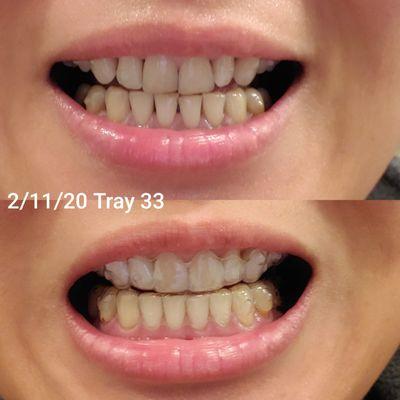 Pix 3.) She's trying to fix her mistake, this is 2nd set of 33/34 trays. Still couldn't fix my teeth after the 2nd set. almost 4 yrs later..