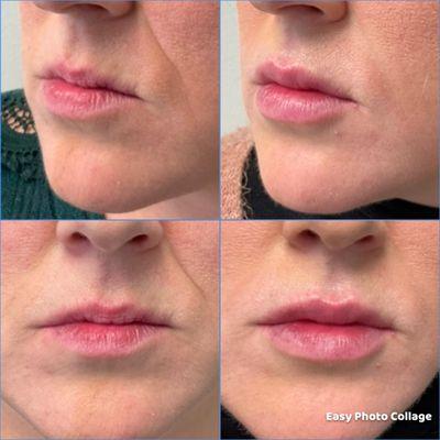 Dermal filler for lines and lips!