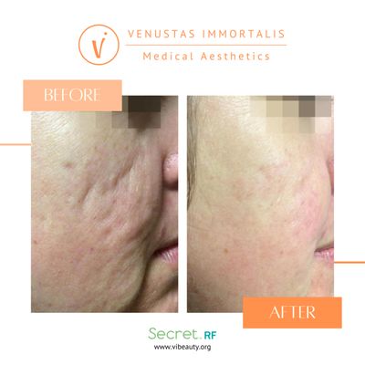 RF Microneedling Before & After - Med Spa in Janesville, WI