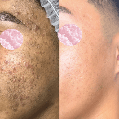 Acne customized treatment