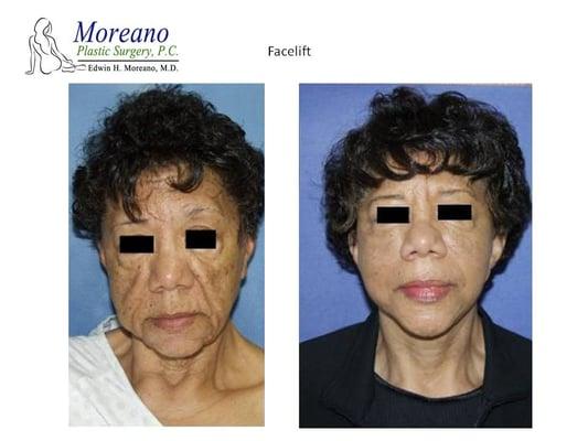 A modern Facelift procedure, Dr. Moreano is an expert in Facial Plastic Surgery, and will turn back time, and make you look years younger