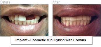 Implant - Cosmetic Mini Hybrid With Crowns