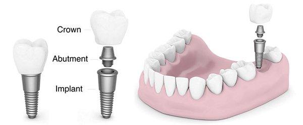 Dental Implants in Clifton NJ 07011