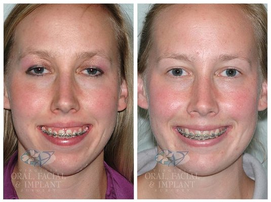 Jaw surgery