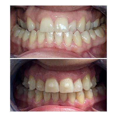 Invisalign Case. Beautiful smile!