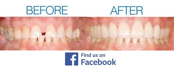 Before & Afters of Dr. Martinez's Work - Case #3