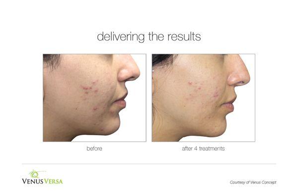 Before & After | Acne | 4 treatments *results vary between clients*