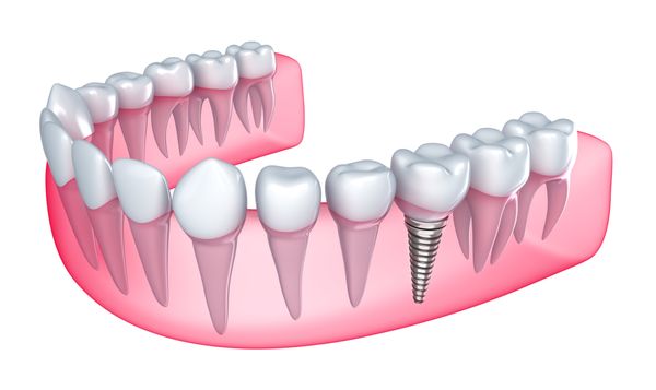 NYC Dental Implant Center