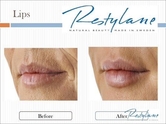 Restylane SIlk for Lips!