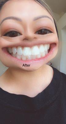 After fixing discoloration and cavity