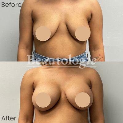 Bilateral Breast Augmentation with 450ml Silicone Implants Before and After