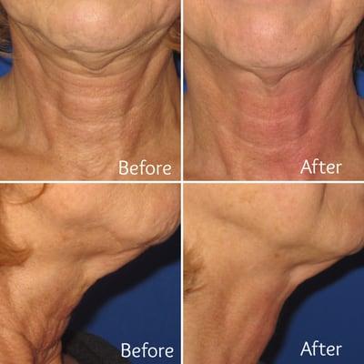 Fractora Firm - Before and after