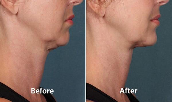 Neck Lift with Kybella