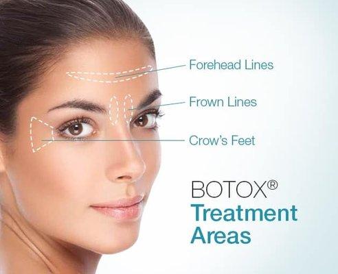 Botox treatment areas.