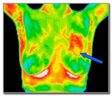 Thermographically significant  scan showing an area of concern which ended up being cancer