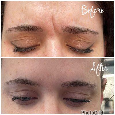 Xeomin got rid of these frown lines