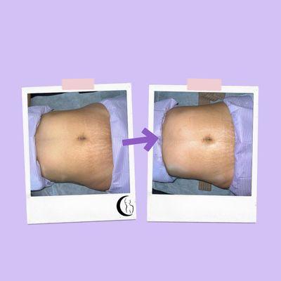 Before and after results of our Bloat Therapy service.